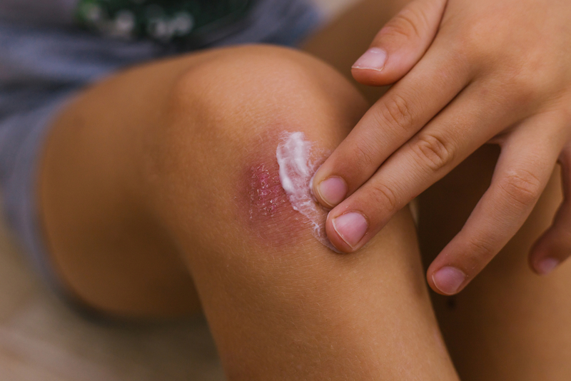 Help Heal Cuts, Scrapes, and Burns | Alie04/Shutterstock