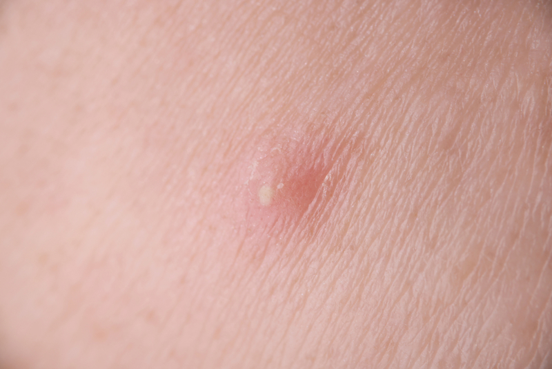 Elimina los forúnculos de la piel | Getty Images Photo by megaflopp